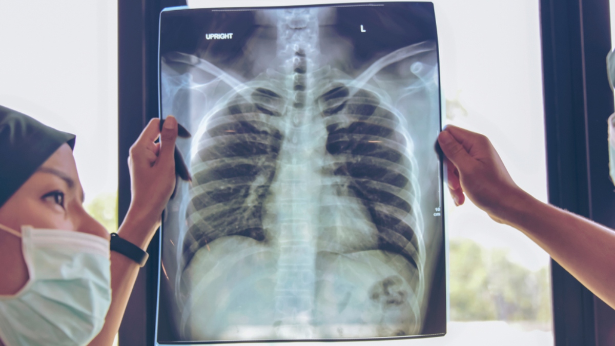 Los servicios de tuberculosis se encuentran entre muchos otros interrumpidos por la pandemia de COVID-19 en 2021.